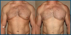 gynecomastia-steroids-bodybuilder