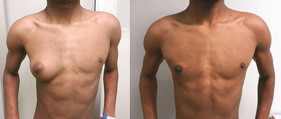 gynecomastia testosterone abuse